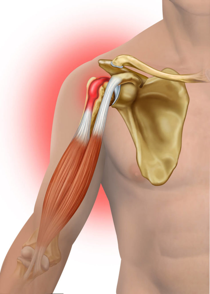 anatomy of bicep tendonitis