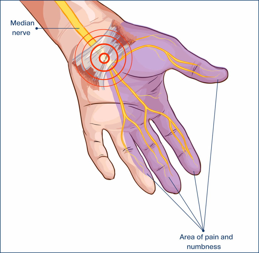 anatomy of carpal tunnel syndrome