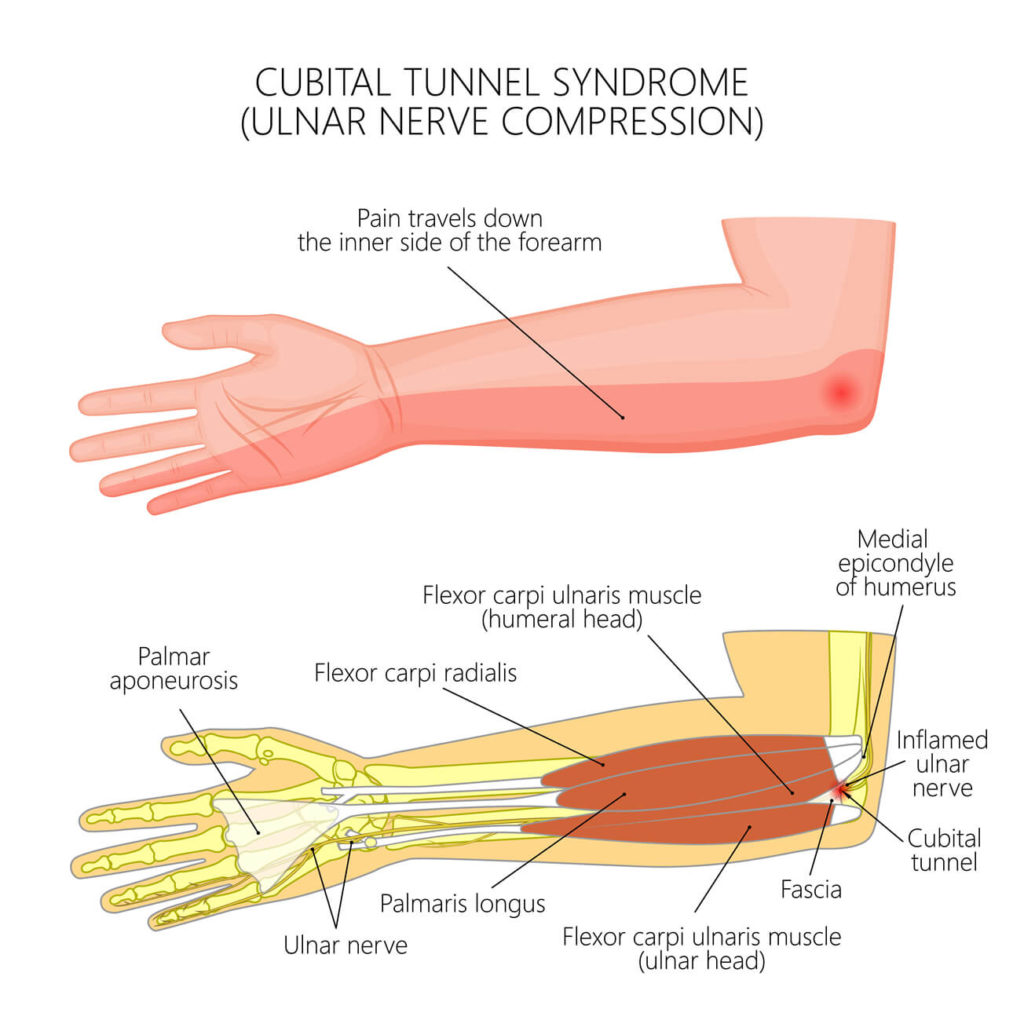 anatomy of cubital tunnel syndrome
