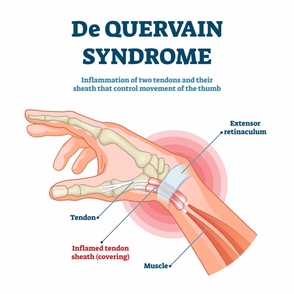 anatomy of De Quervain's syndrome