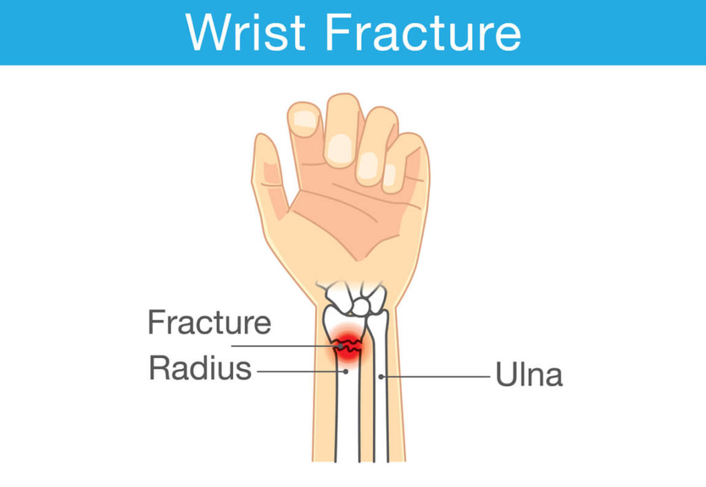 anatomy of a wrist fracture