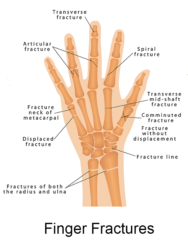 anatomy of finger fractures