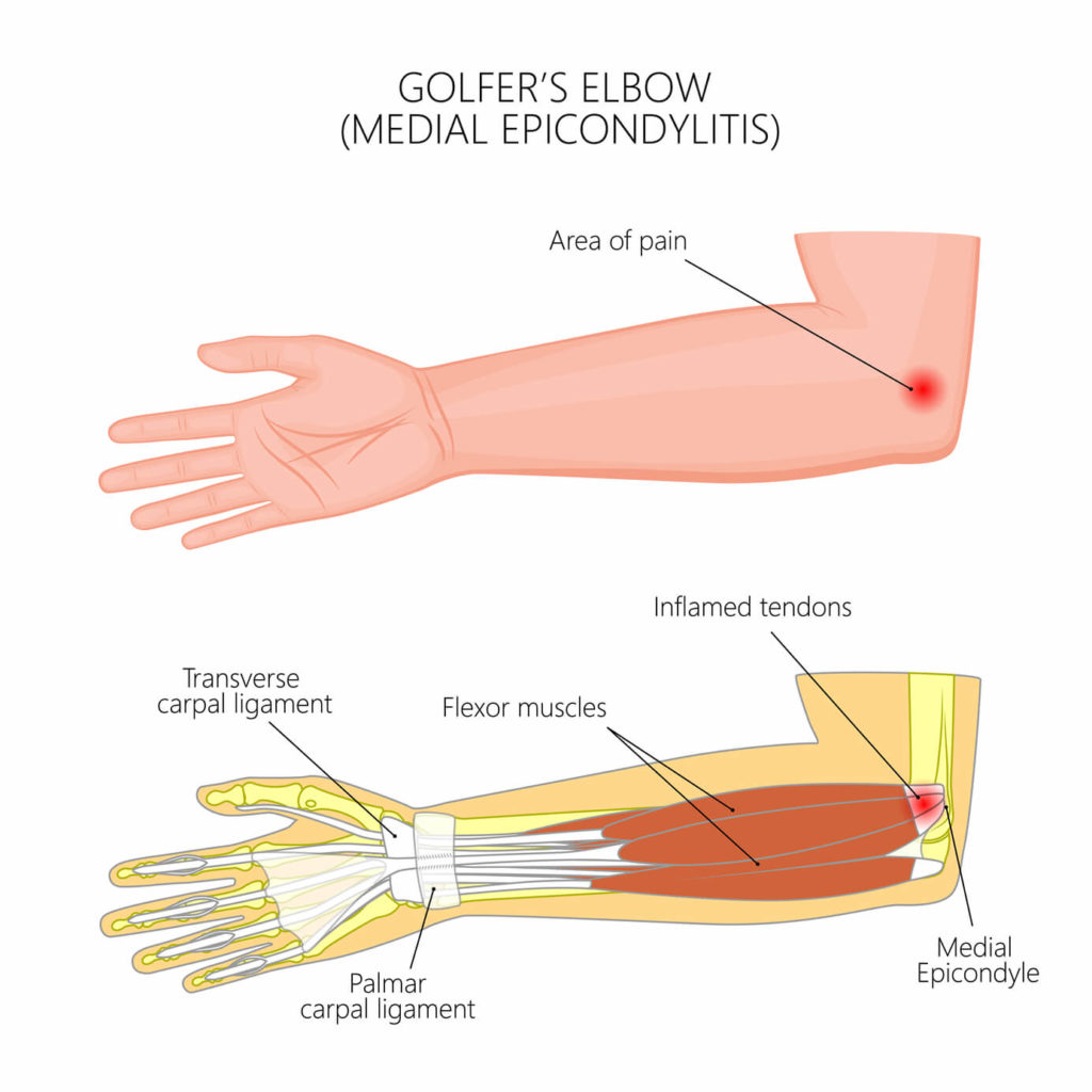 anatomy of golfer's elbow