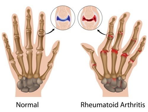 representation of the difference between normal hand joints and hand joints that have rheumatoid arthritis