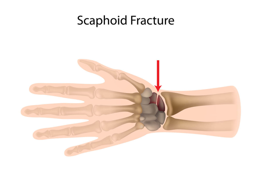 anatomy of a scaphoid fracture