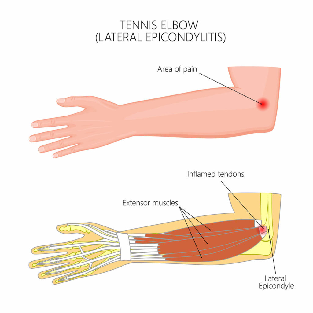 anatomy of tennis elbow