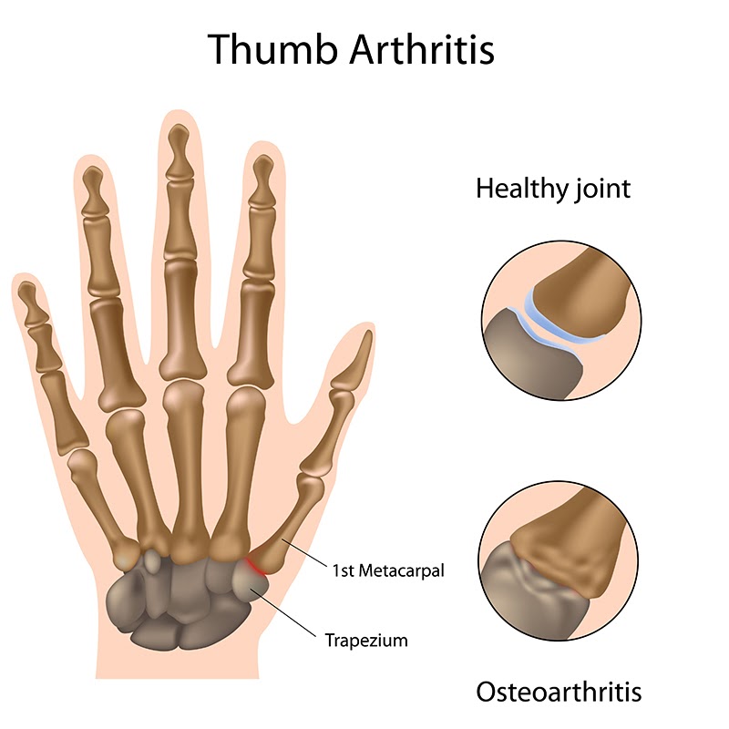 anatomy of thumb arthritis