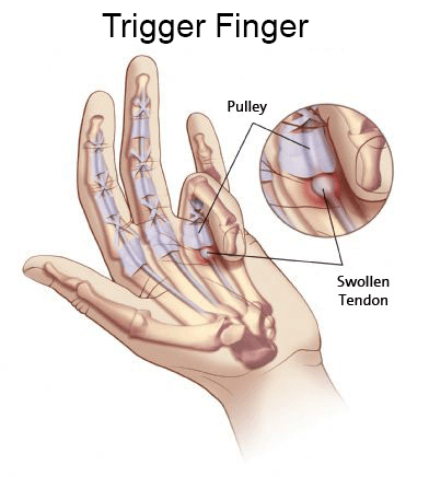 anatomy of trigger finger
