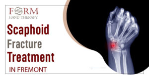 Scaphoid Fracture Treatment in Fremont